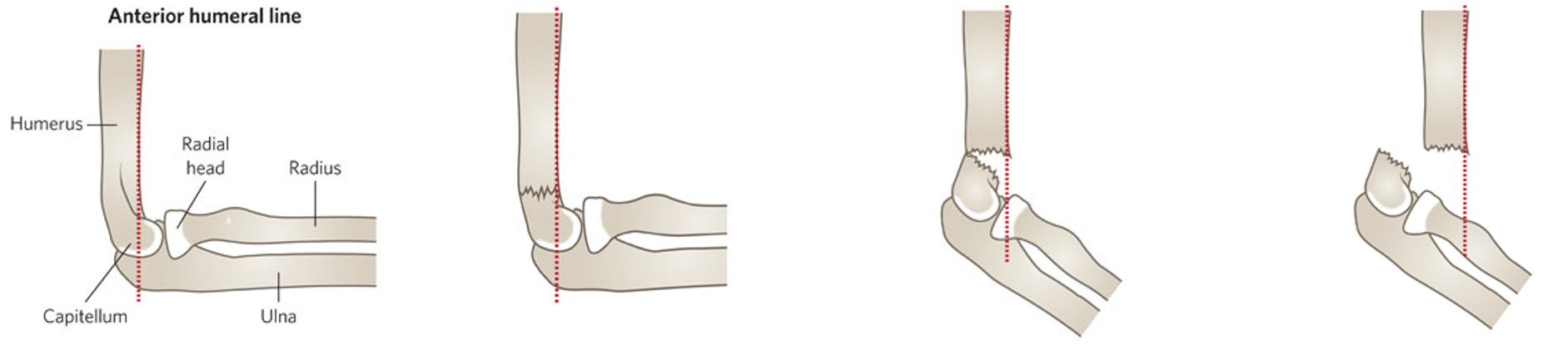 Elleboog Kind_Humerus Supra- en transcondylaire fractuur_1a.png