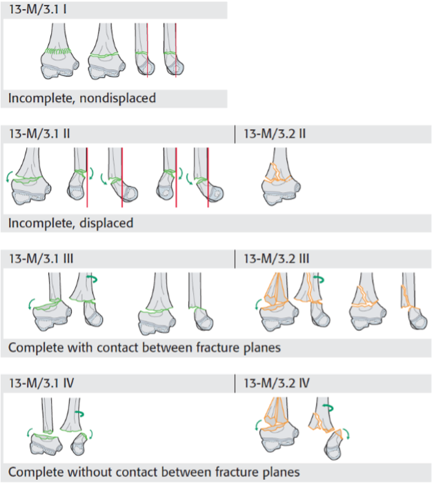 Elleboog Kind_Humerus Supra- en transcondylaire fractuur_2.png